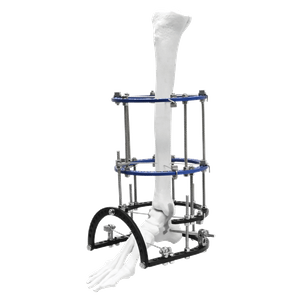 Ankle Fusion Илизарова Фиксатор