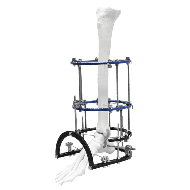 Ankle Fusion Илизарова Фиксатор